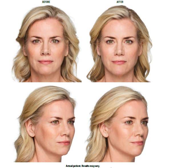 Dermal Fillers in Jupiter, FL