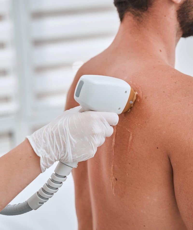 Laser Hair Removal in Jupiter, FL